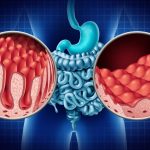 Does Serum Anti-tissue Transglutaminase Level Predict Duodenal Histopathology and Clinical Manifestations of Celiac Disease in Adults?