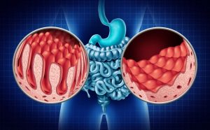 Does Serum Anti-tissue Transglutaminase Level Predict Duodenal Histopathology and Clinical Manifestations of Celiac Disease in Adults?